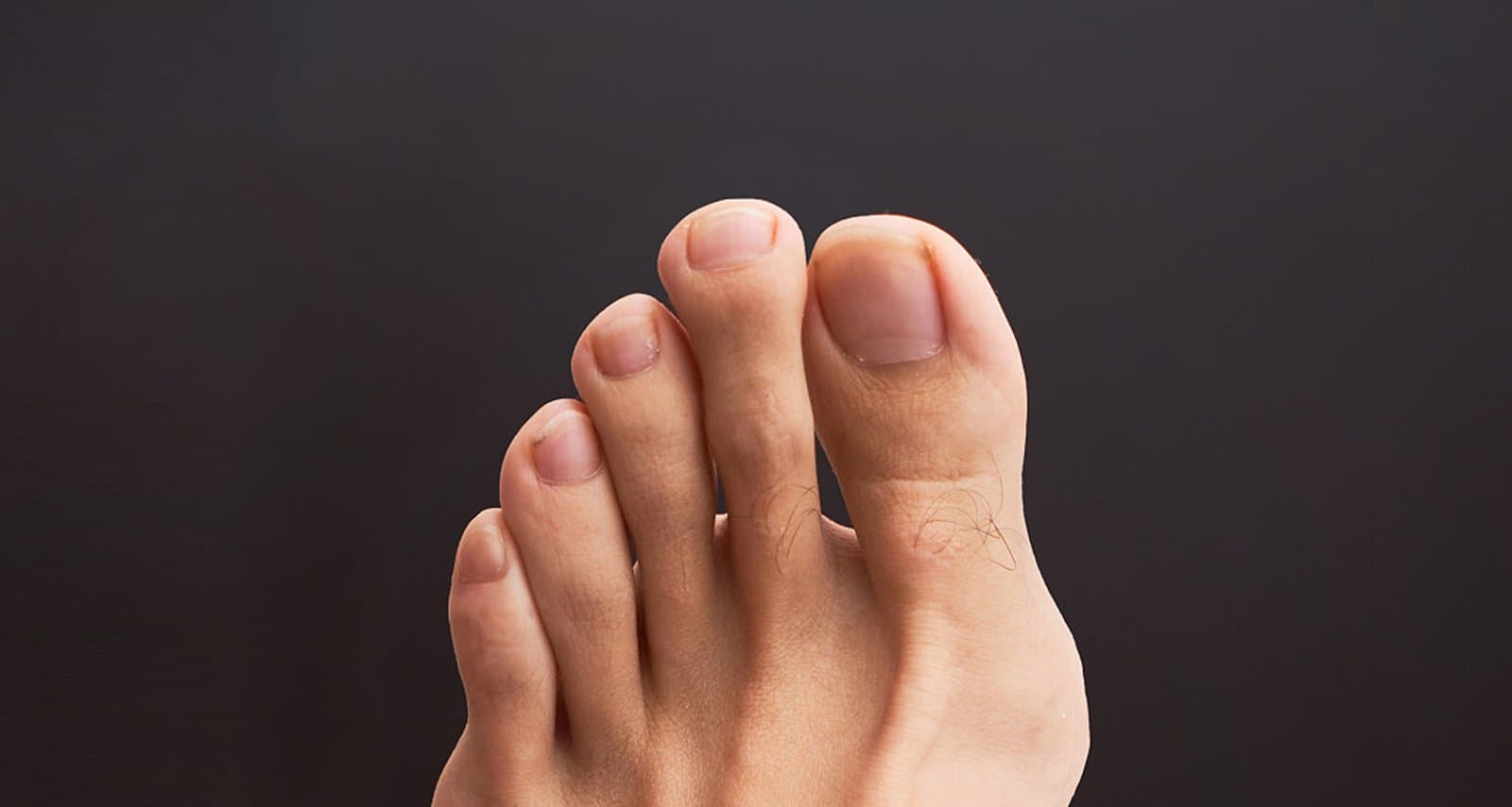 Bunions