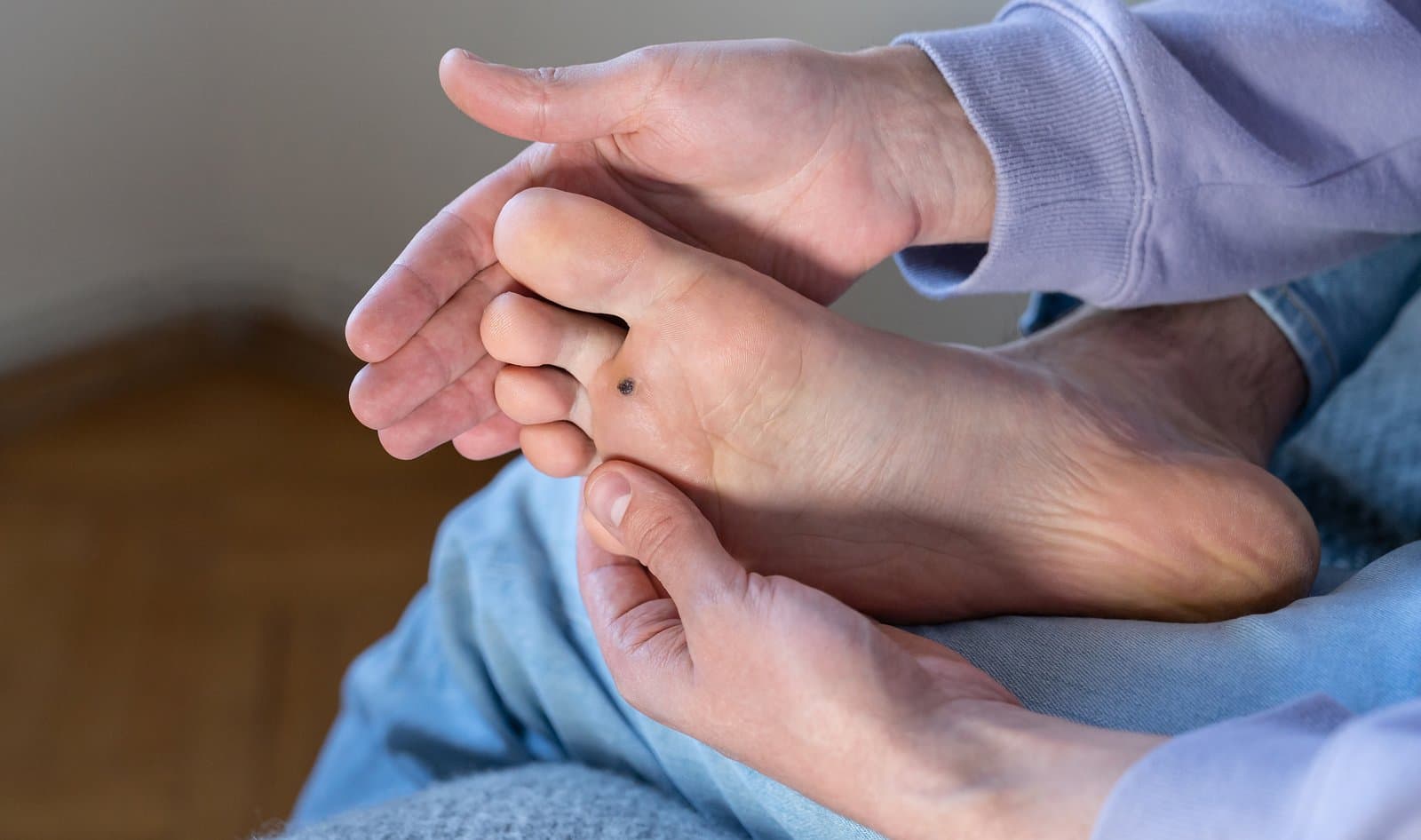 Corn vs Wart: What’s the Difference?