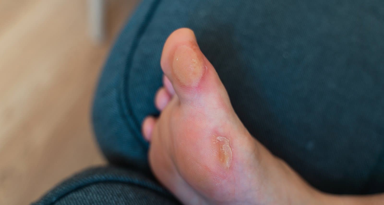 Corns and Calluses