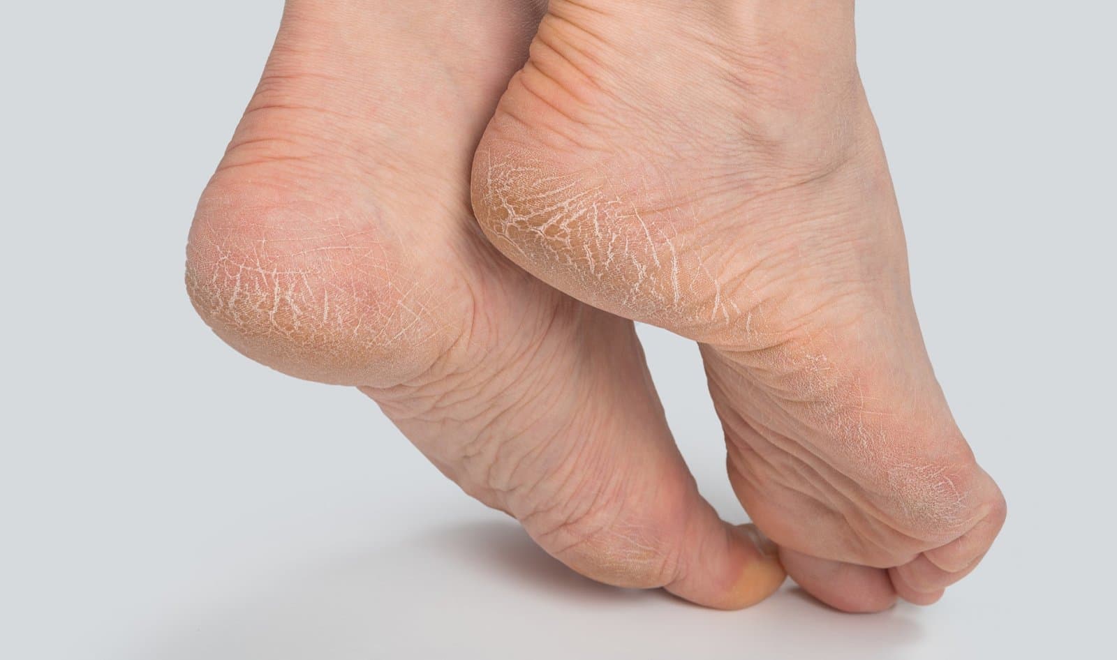 Cracked Heels (Dry, Split Heels)
