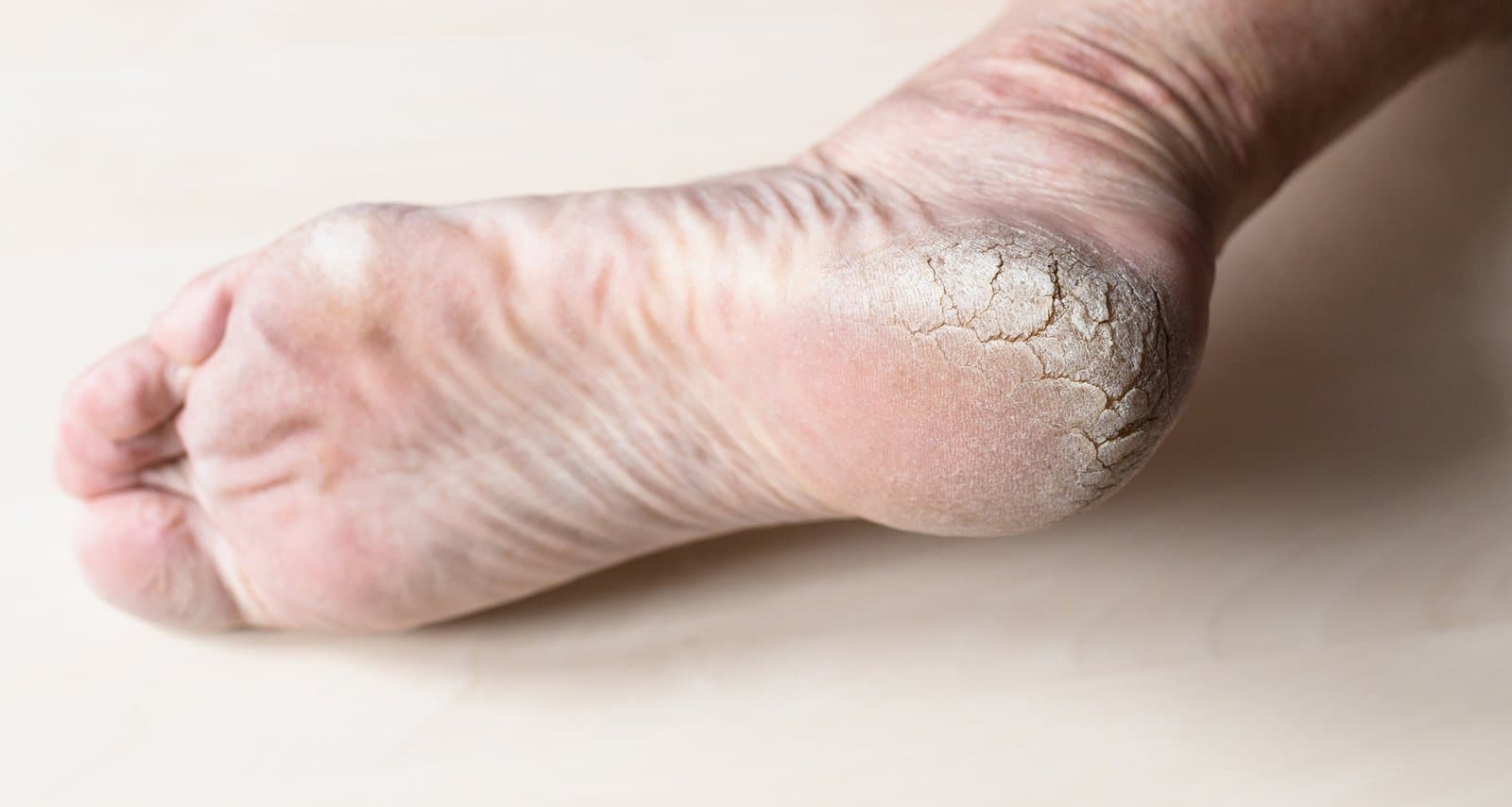 Cracked Heels