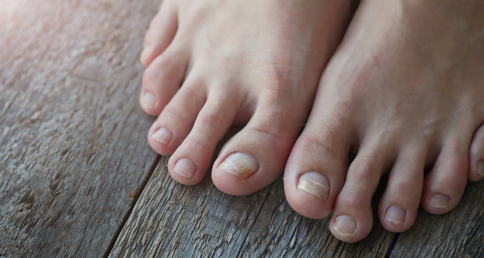 Fungal Nails