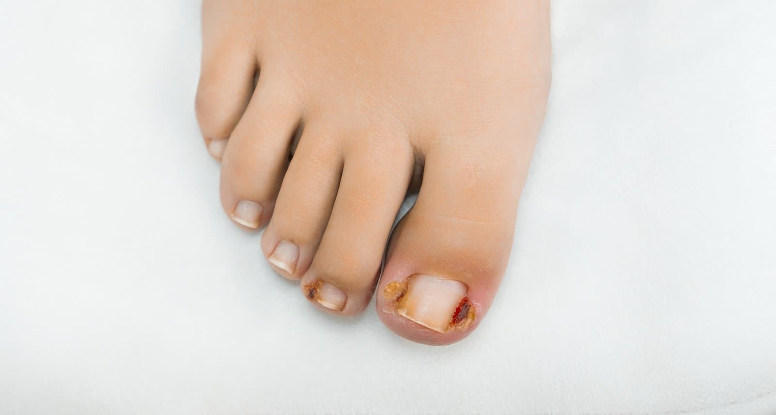 Ingrown Toenails