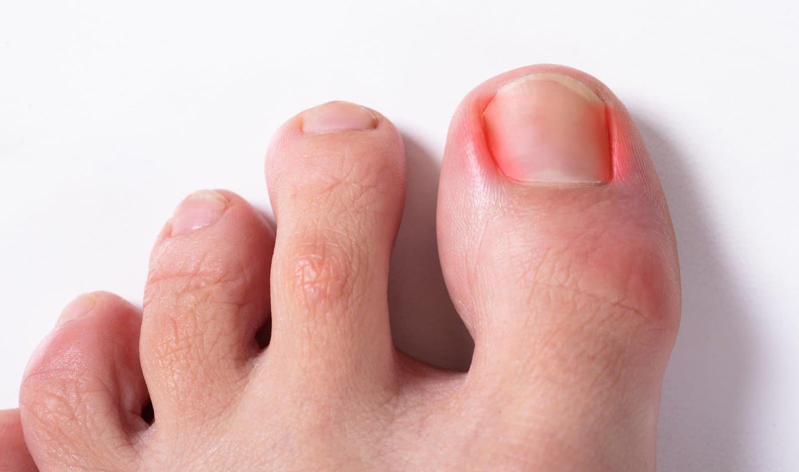 Low Level Laser Therapy (LLLT)