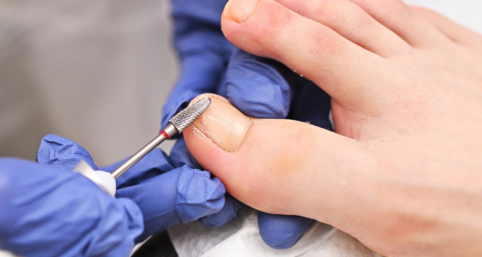 Nail Surgery
